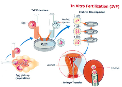 Importance Of In Vitro Fertilization