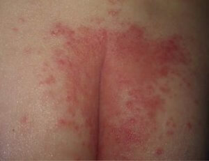 Diaper rash: All you want to know about it