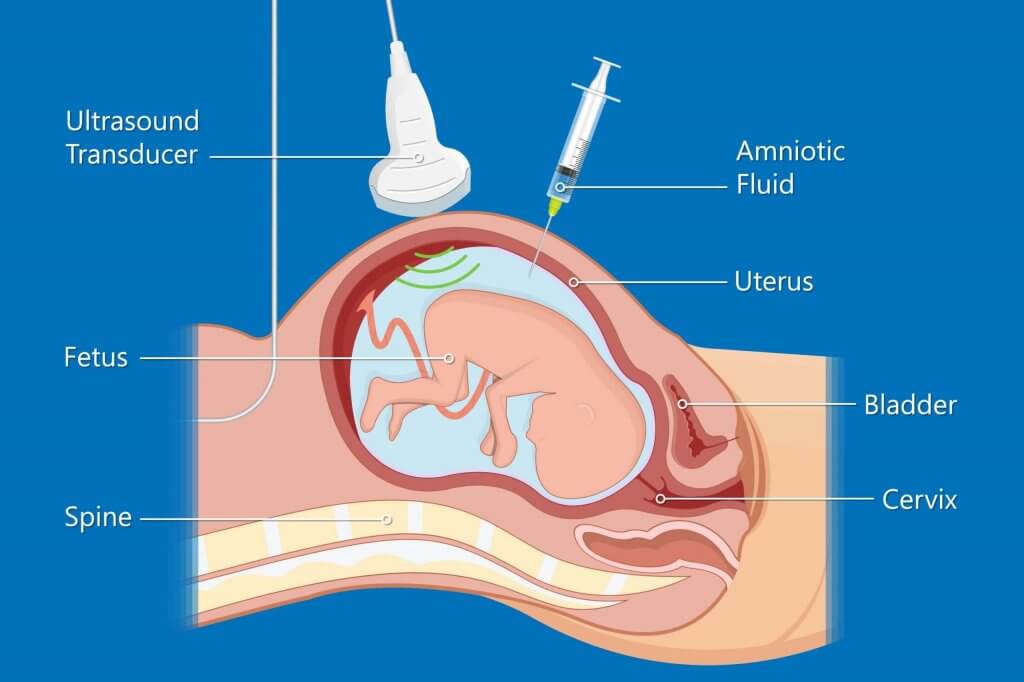 What is amniocentesis?